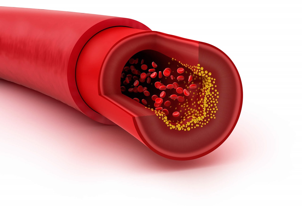 Định lượng cholesterol toàn phần cao cảnh báo điều gì?