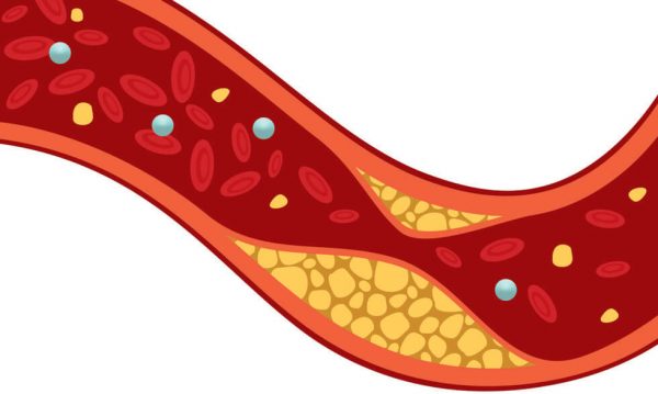 Định lượng cholesterol toàn phần cao cảnh báo điều gì?