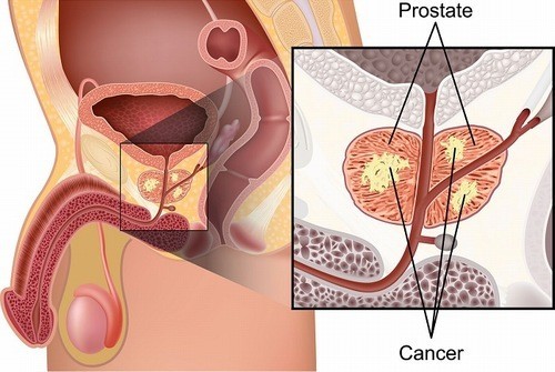 Định lượng PSA tuyến tiền liệt bị viêm hoặc phì đại