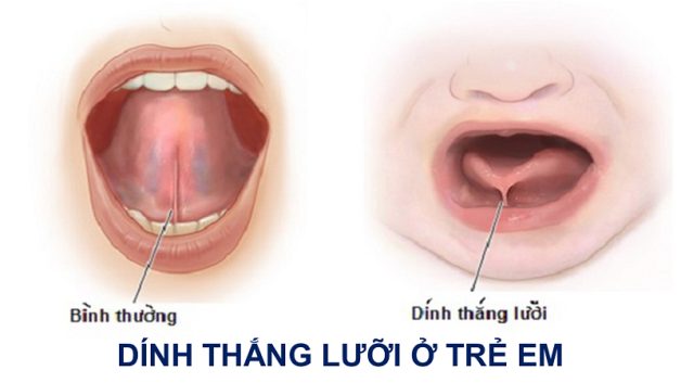 Dính thắng lưỡi – Dị tật nhỏ, ảnh hưởng to