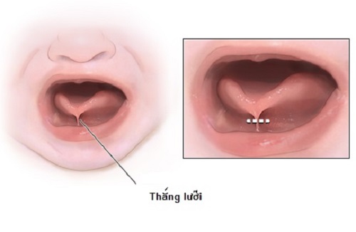 Dính thắng lưỡi ở trẻ và những điều cần biết