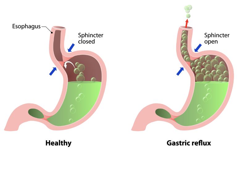 Đo HRM: Kỹ thuật giúp khẳng định các triệu chứng tương tự GERD