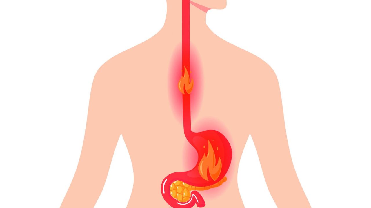 Đo PH24H – Cứu cánh cho người bị ợ chua nóng rát cổ lâu năm