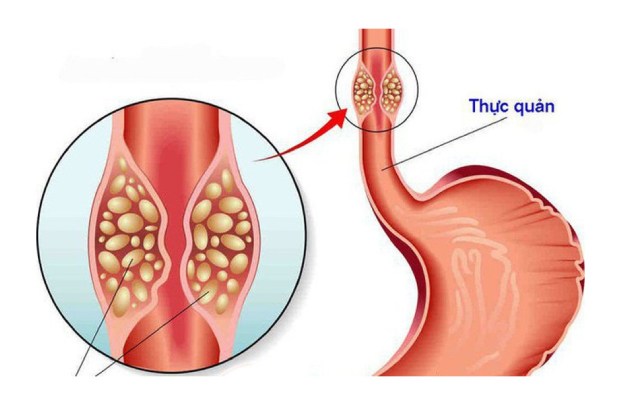 Độ tuổi thích hợp nên tầm soát ung thư đường tiêu hóa