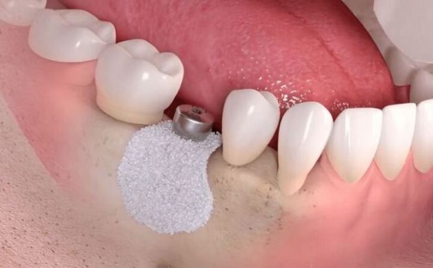 Đối tượng cần ghép xương trong cấy ghép implant