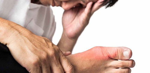 Đối tượng nào dễ mắc bệnh gout? Lời khuyên bệnh gout