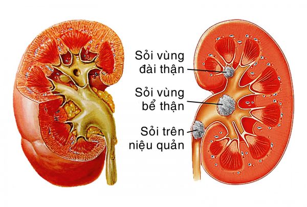 Đối tượng nào dễ mắc sỏi đường tiết niệu?