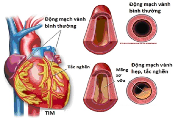 Động mạch vành tim: Cấu tạo, hoạt động và bệnh lý