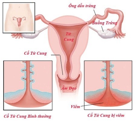 Đốt cổ tử cung có đau không bệnh về viêm lộ tuyến cổ tử cung