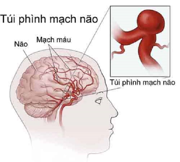 Đột quỵ khi quan hệ tình dục – Những điều cần biết