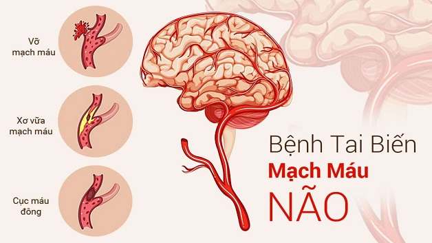 Đột quỵ não – Căn bệnh nguy hiểm không thể coi thường