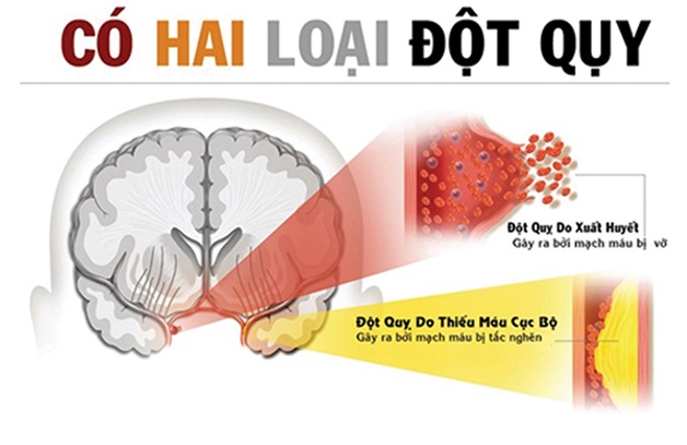 Đột quỵ não có nguy hiểm không và cách nhận biết