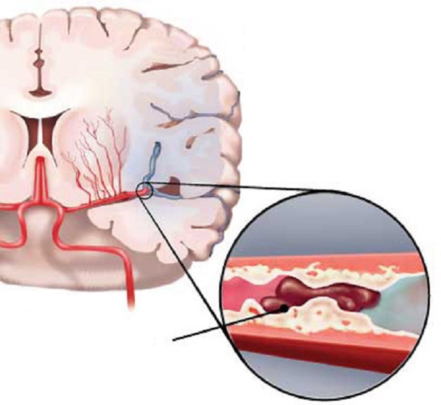 Đột quỵ não: phân loại và cách phòng ngừa