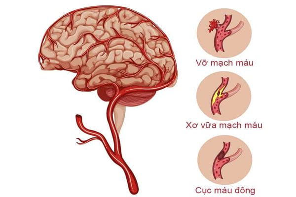 Đột quỵ não và các phương pháp điều trị hiện nay