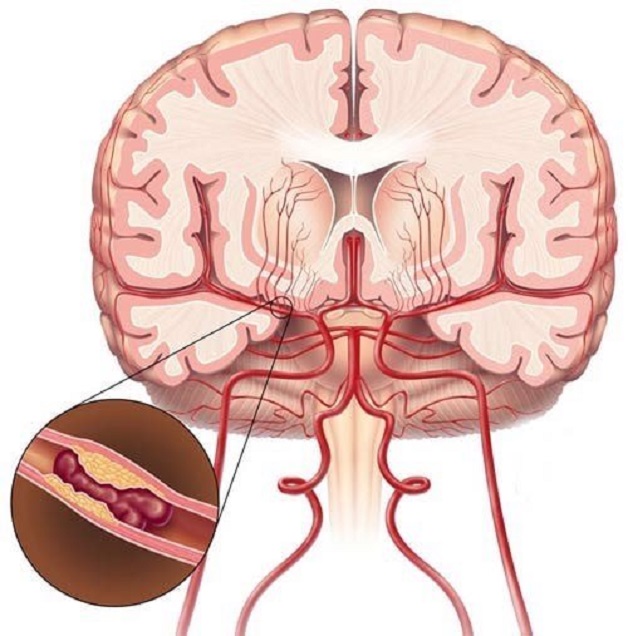 Đột quỵ nhồi máu não ngày càng phổ biến và trẻ hóa