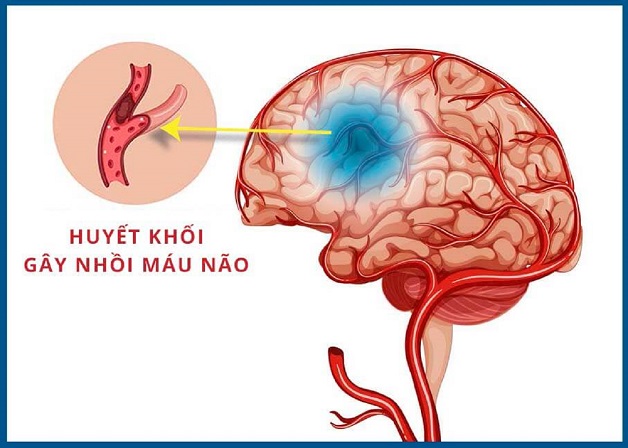 Đột quỵ nhồi máu não: nguyên nhân và cách chẩn đoán