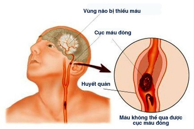 Đột quỵ nhồi máu não: Những điều không thể bỏ qua!