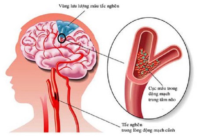 Đột quỵ sơ cứu như thế nào để đạt hiệu quả cao?