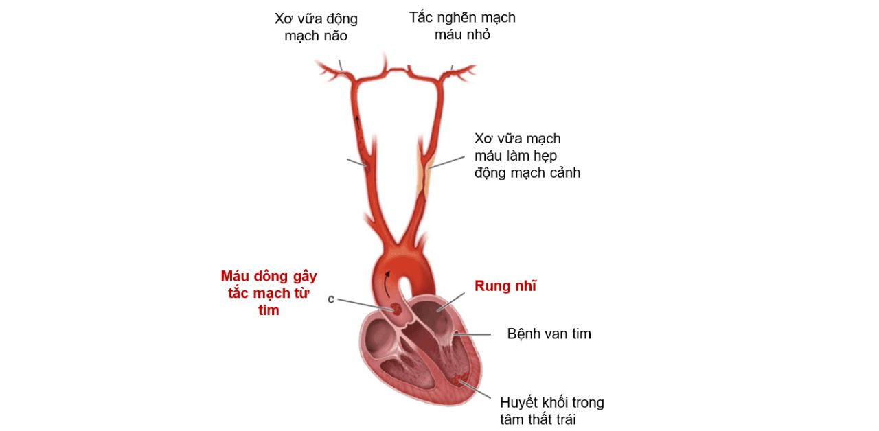 Đột quỵ trong rung nhĩ: Nguyên nhân, cách phòng ngừa