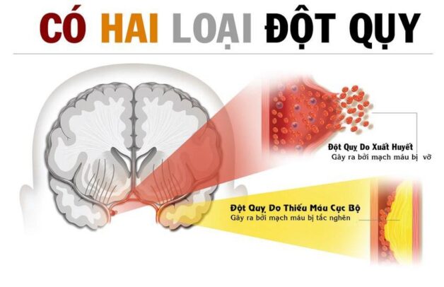 Đột quỵ và cách xử trí cần lưu ý