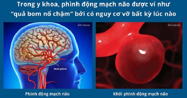 Đột quỵ xuất huyết não cực nguy hiểm, cần nhận biết kịp thời