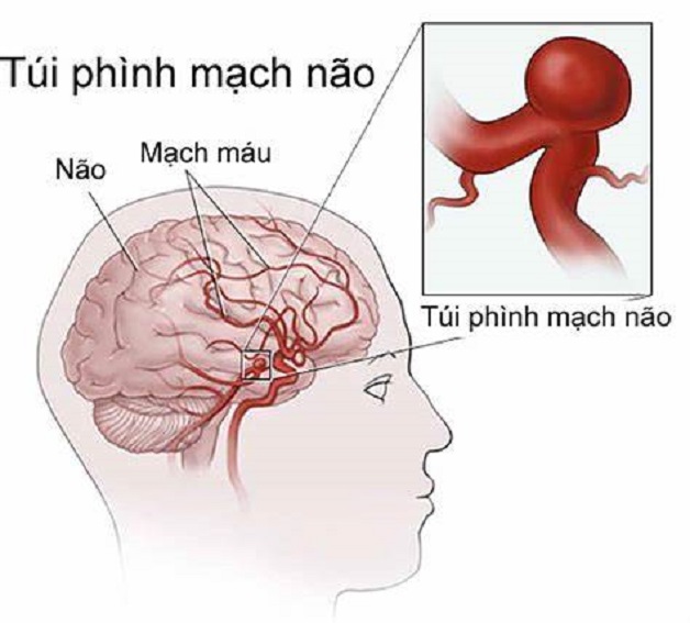 Đột quỵ xuất huyết não đang trẻ hóa