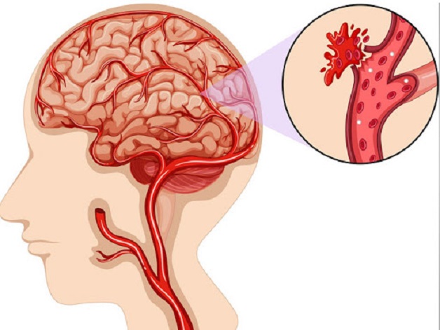 Đột quỵ xuất huyết não: Triệu chứng, nguyên nhân