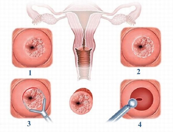 Đốt viêm lộ tuyến cổ tử cung