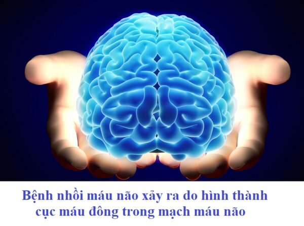 Dự phòng sa sút trí tuệ ngay từ sớm là rất cần thiết