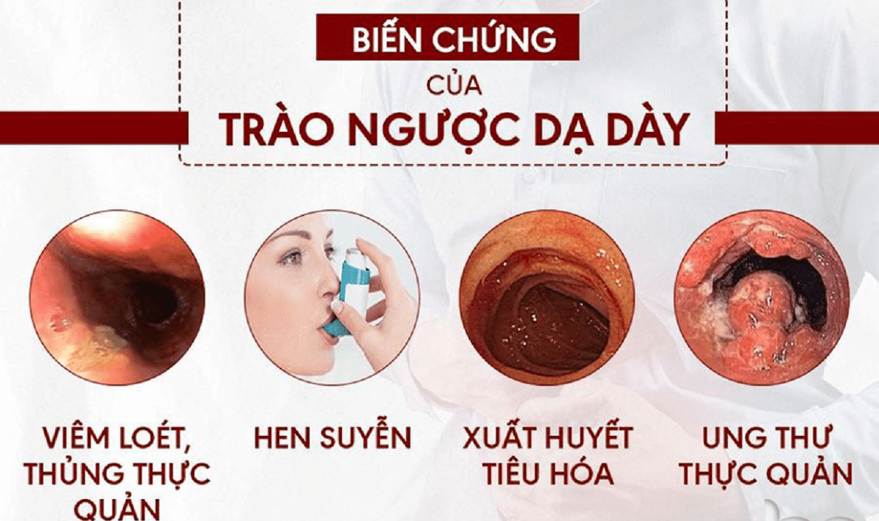 Đừng chủ quan: Biến chứng của trào ngược dạ dày 