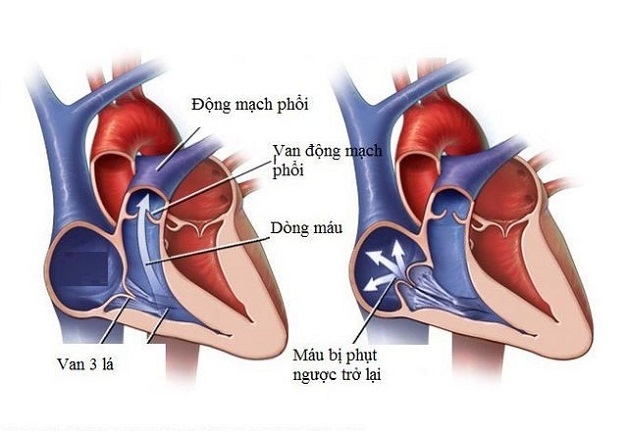 Đừng chủ quan trước nguy cơ bị hở van tim 3 lá