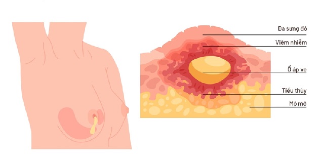 Đừng chủ quan với áp xe vú ở nam giới