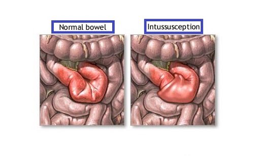 Đừng chủ quan với bệnh lồng ruột ở trẻ em