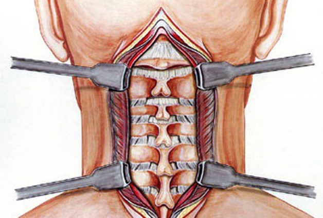 Đừng chủ quan với bệnh vôi đốt sống cổ