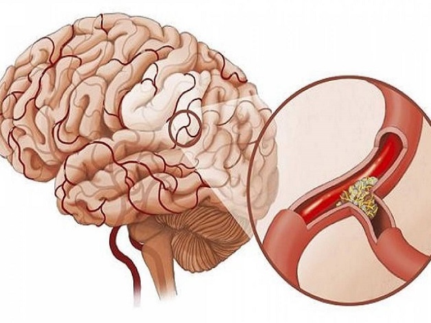 Đừng chủ quan với cơn tai biến mạch máu não thoáng qua 