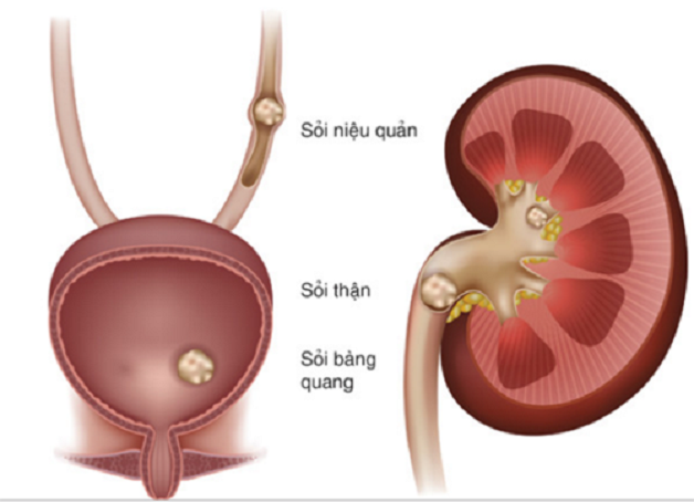 Đừng chủ quan với hiện tượng sỏi thận ở bàng quang