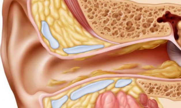 Đừng chủ quan với viêm tai giữa ở người lớn