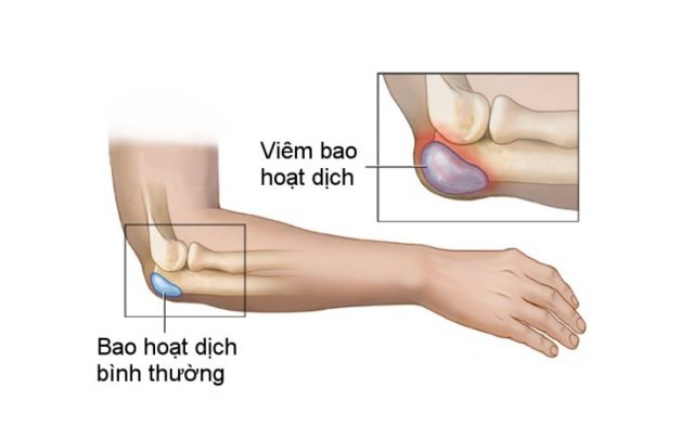 Đừng coi thường cơn đau khớp khuỷu tay