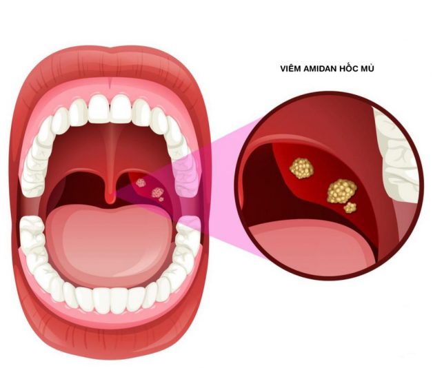 Đừng coi thường viêm amidan cấp mủ