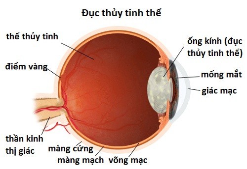 Đừng để bệnh đục thủy tinh thể gây mù lòa