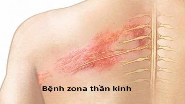 Đừng lơ là trước những DẤU HIỆU zona thần kinh ở trẻ em