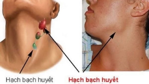 Đừng nhầm lẫn ung thư hạch bạch huyết và cảm cúm