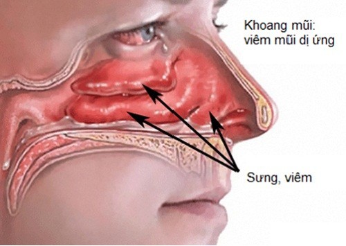 Đừng xem nhẹ bệnh viêm mũi xoang dị ứng