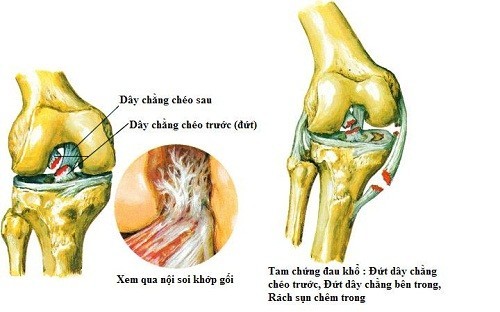 Đứt dây chằng chéo trước có nguy hiểm không