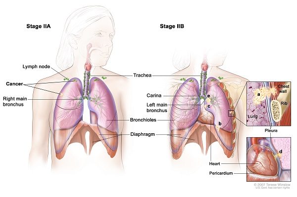 【Tổng hợp】Ung thư phổi giai đoạn 2