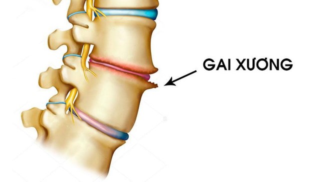 Gai đốt sống cổ là bệnh gì, có thể điều trị được không?