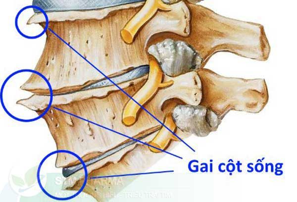 Gai xương – dấu hiệu của xương bị thoái hóa