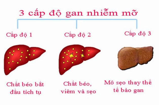 Gan nhiễm mỡ có mấy cấp độ và nguy hiểm thế nào