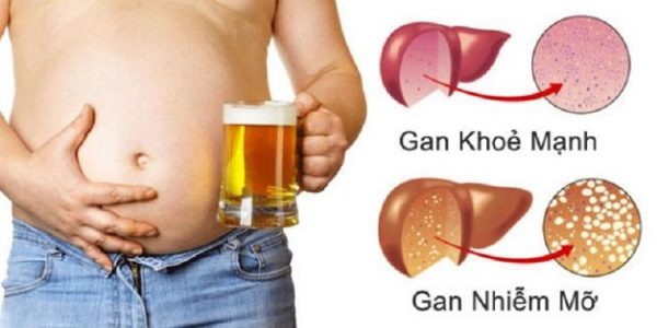 Gan nhiễm mỡ có nguy hiểm không theo mỗi giai đoạn bệnh