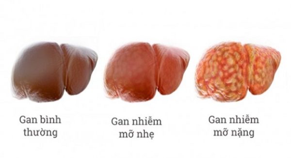 Gan nhiễm mỡ có nguy hiểm không theo mỗi giai đoạn bệnh